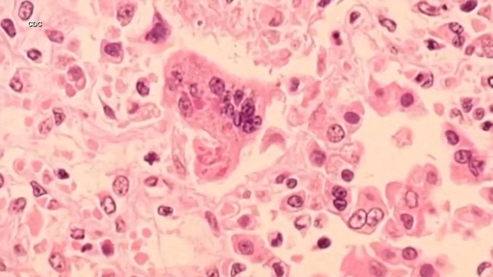 Health officials confirm case of measles in a Santa Clara County resident